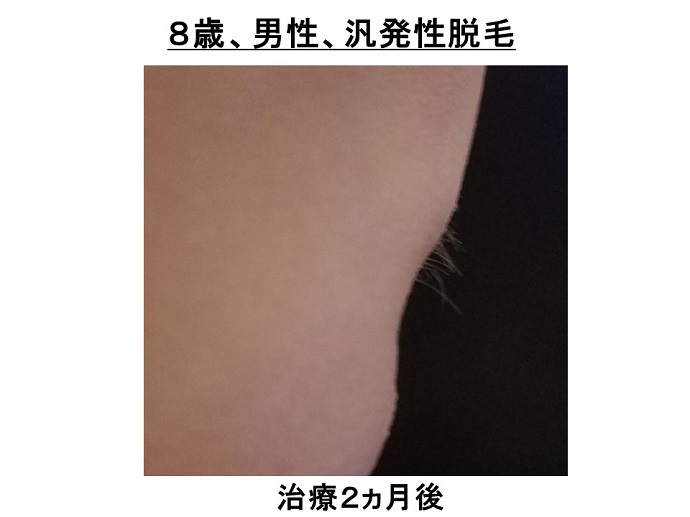円形脱毛症　病院